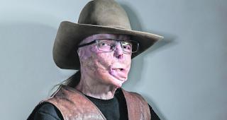 Haltung. Trotz der tragischen Verletzung l&auml;sst sich Marcel Mathis nicht unterkriegen.  