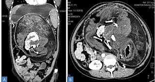 In der Mitte ist der fehlentwickelte Zwilling zu sehen. (CT-Scan)